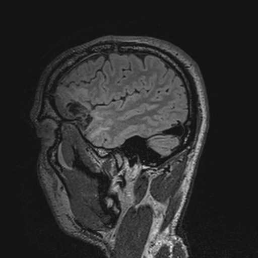File:Cerebral hemorrhagic contusions- temporal evolution (Radiopaedia 40224-42757 Sagittal T1 65).png