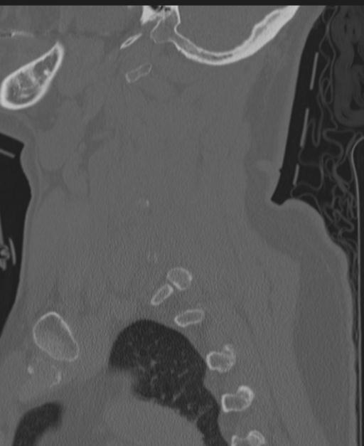 Cerebral hemorrhagic contusions and cervical spine fractures (Radiopaedia 32865-33841 Sagittal bone window 27).jpg