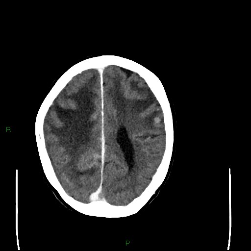 Cerebral metastases - breast primary (Radiopaedia 77653-89857 Axial C+ delayed 79).jpg