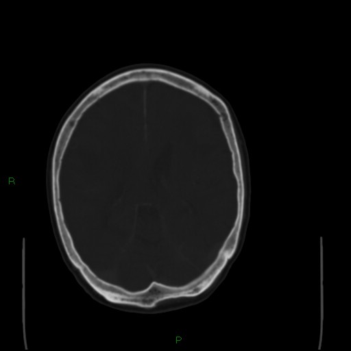 File:Cerebral metastases - breast primary (Radiopaedia 77653-89857 Axial bone window 69).jpg