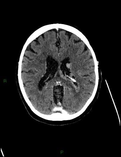 File:Cerebral metastases - ependymal and parenchymal (Radiopaedia 79877-93131 Axial C+ delayed 48).jpg