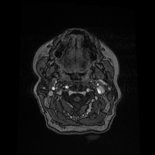 Cerebral metastases - melanoma (Radiopaedia 80972-94522 Axial T1 C+ 9).jpg