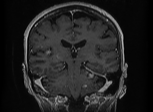 Cerebral metastases from lung cancer with amyloid angiopathy and cerebellopontine angle meningioma (Radiopaedia 74306-85191 Coronal T1 C+ 36).jpg