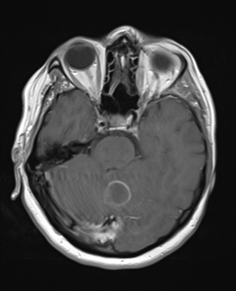 File:Cerebral metastases mimicking abscesses (Radiopaedia 45841-50131 Axial T1 C+ fat sat 10).png
