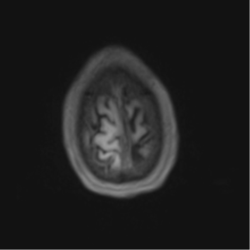 File:Cerebral metastasis - melanoma (Radiopaedia 54718-60954 Axial T1 48).png