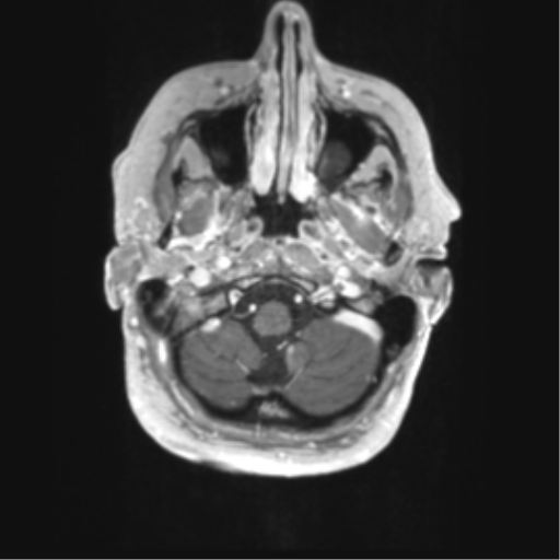 Cerebral metastasis mimicking glioblastoma (Radiopaedia 69155-78937 Axial T1 C+ 3).png
