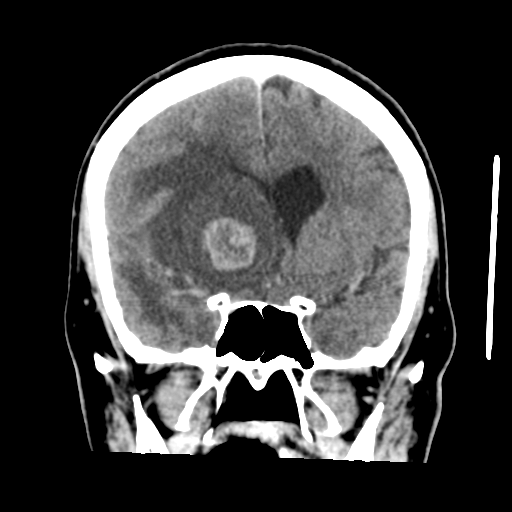 Cerebral metastasis to basal ganglia (Radiopaedia 81568-95412 Coronal C+ delayed 25).png