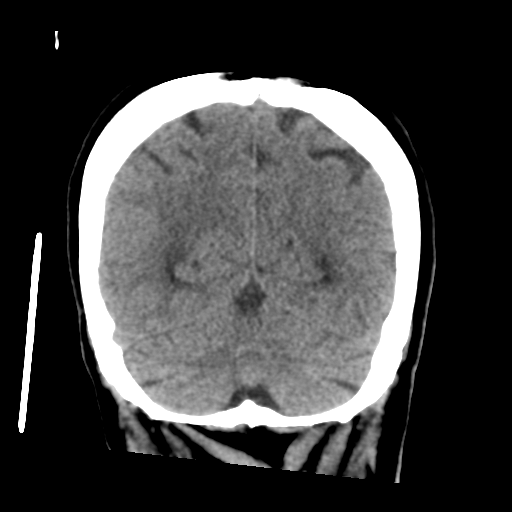 Cerebral metastasis to basal ganglia (Radiopaedia 81568-95412 Coronal non-contrast 52).png