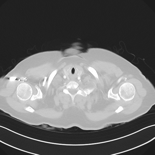 File:Cerebral metastasis to basal ganglia (Radiopaedia 81568-95414 Axial lung window 2).png