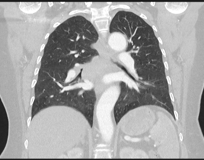 File:Cerebral metastasis to basal ganglia (Radiopaedia 81568-95414 Coronal lung window 53).png