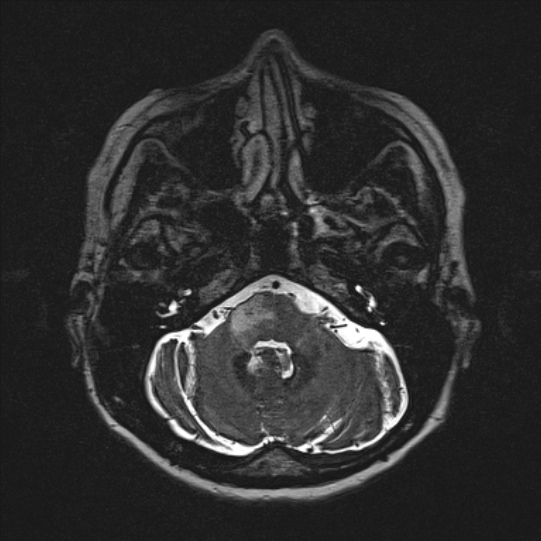 Cerebral ring enhancing lesions - cerebral metastases (Radiopaedia 44922-48817 F 28).jpg