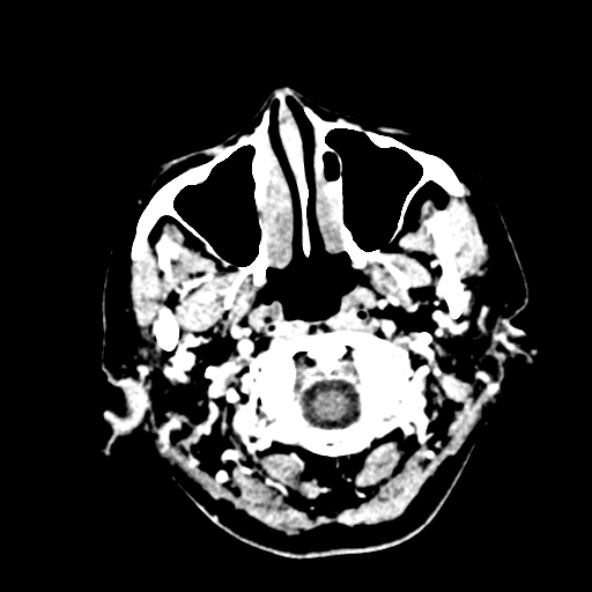 File:Cerebral ring enhancing lesions - cerebral metastases (Radiopaedia 44922-48818 B 15).jpg