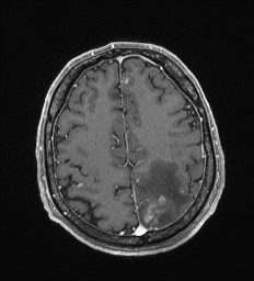 Cerebral toxoplasmosis (Radiopaedia 43956-47461 Axial T1 C+ 58).jpg