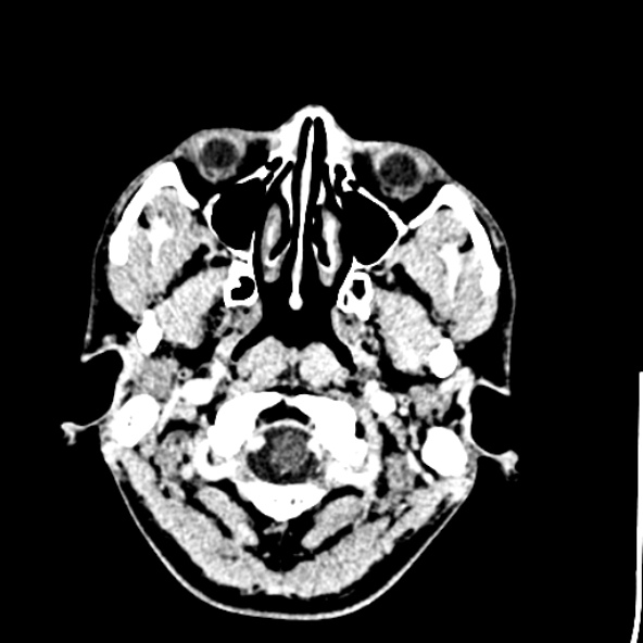 Cerebral toxoplasmosis (Radiopaedia 53993-60131 Axial C+ delayed 6).jpg