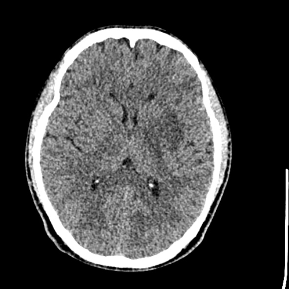 Cerebral toxoplasmosis (Radiopaedia 53993-60131 Axial non-contrast 42).jpg