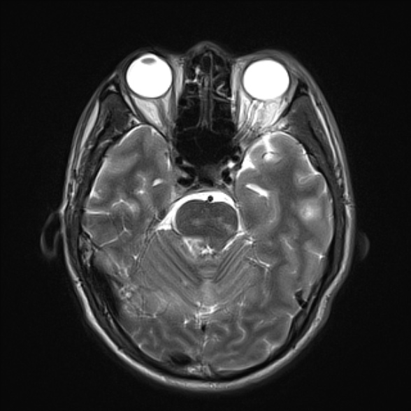 File:Cerebral toxoplasmosis (Radiopaedia 53993-60132 Axial T2 9).jpg