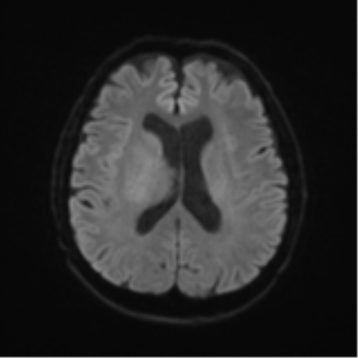 Cerebral toxoplasmosis (Radiopaedia 54575-60804 Axial DWI 52).png