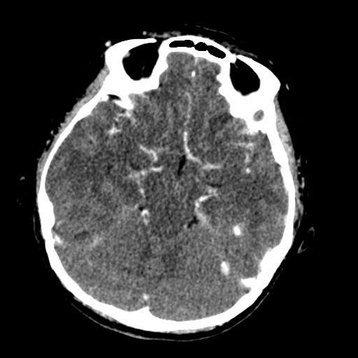 Cerebral tuberculosis with dural sinus invasion (Radiopaedia 60353-68019 Axial C+ delayed 22).jpg