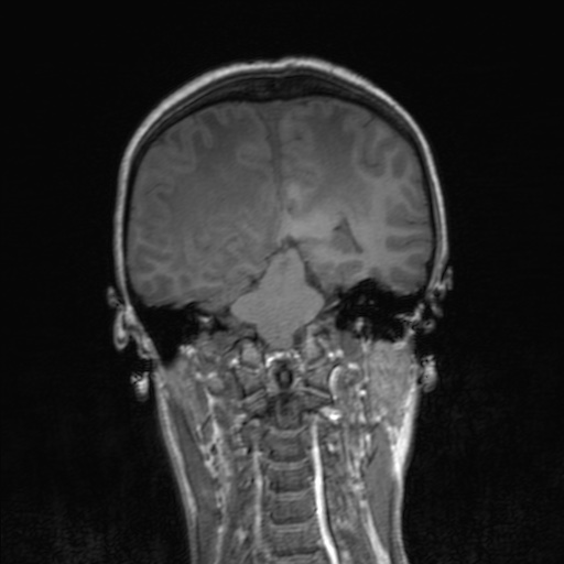 File:Cerebral tuberculosis with dural sinus invasion (Radiopaedia 60353-68090 Coronal T1 118).jpg