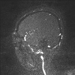 Cerebral tuberculosis with dural sinus invasion (Radiopaedia 60353-68090 Sagittal MRV 25).jpg