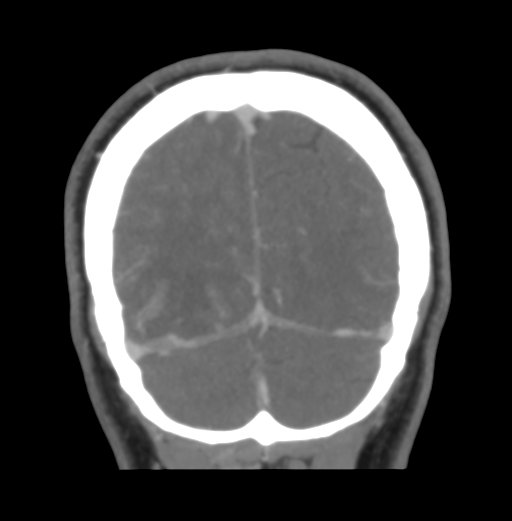 Cerebral venous hemorrhagic infarction (Radiopaedia 38461-40550 Coronal MIP VENOGRAM 50).png
