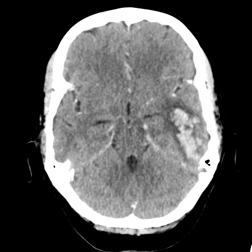 File:Cerebral venous hemorrhagic infarction (Radiopaedia 57576-64538 Axial C+ 16).png