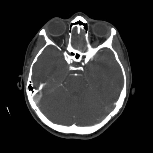 Cerebral venous sinus thrombosis (Radiopaedia 40619-43227 A 77).jpg