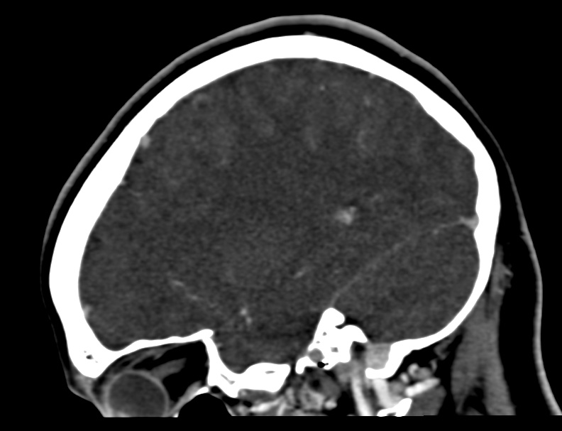 Cerebral venous sinus thrombosis (Radiopaedia 59224-66646 Sagittal C+ delayed 6).jpg