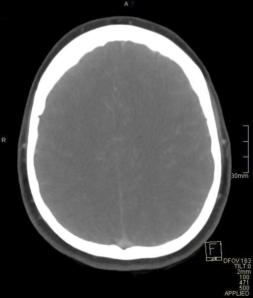 Cerebral venous sinus thrombosis (Radiopaedia 91329-108965 Axial venogram 59).jpg