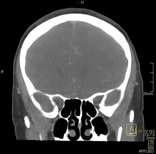 Cerebral venous sinus thrombosis (Radiopaedia 91329-108965 Coronal venogram 29).jpg