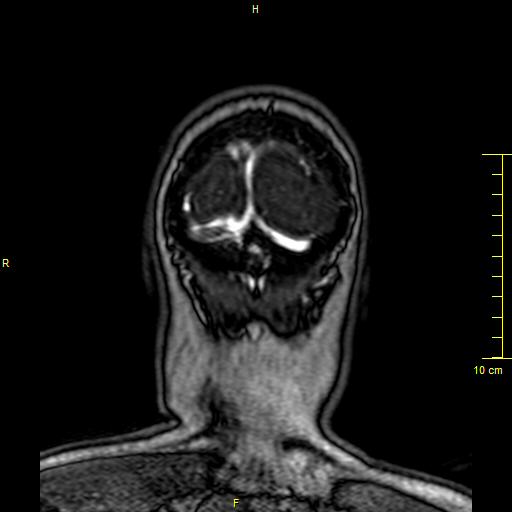 Cerebral venous thrombosis (Radiopaedia 23288-23351 MRV 169).JPG