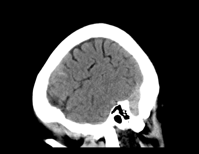 File:Cerebral venous thrombosis (Radiopaedia 38392-40467 C 6).png