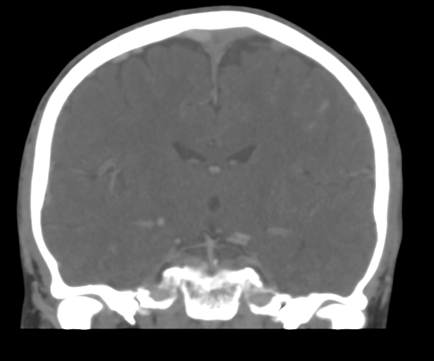 File:Cerebral venous thrombosis (Radiopaedia 38392-40467 Coronal CTA-Venogram 33).png