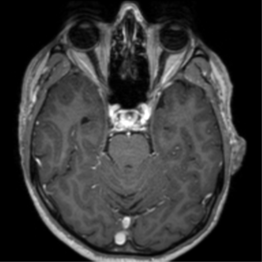 Cerebral venous thrombosis (Radiopaedia 38392-40469 Axial T1 C+ 29).png