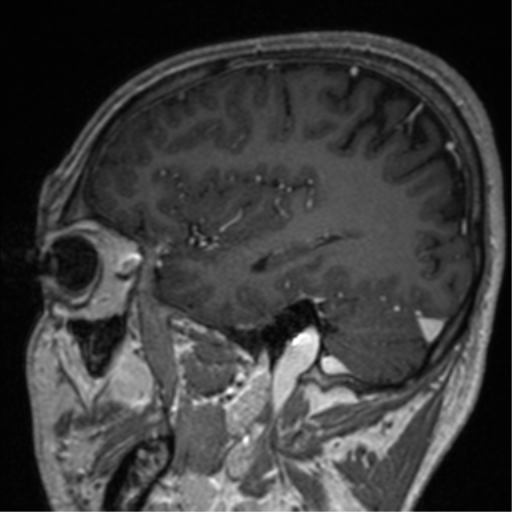 Cerebral venous thrombosis (Radiopaedia 38392-40469 Sagittal T1 C+ 27).png