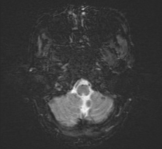 Cerebral venous thrombosis (Radiopaedia 71207-81504 Axial SWI 3).jpg