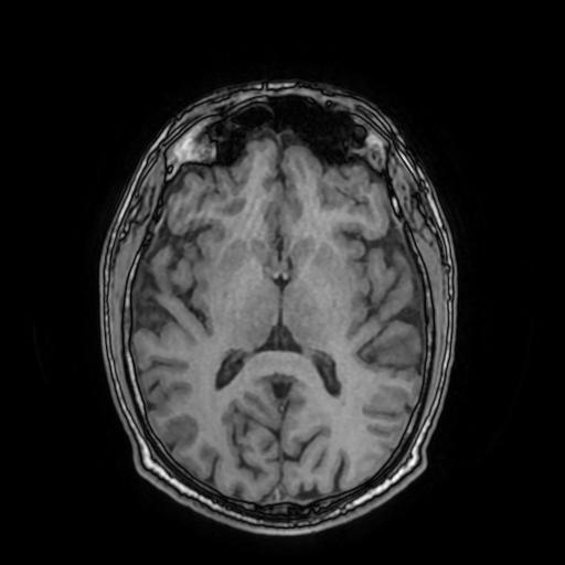 File:Cerebral venous thrombosis with secondary intracranial hypertension (Radiopaedia 89842-106957 Axial T1 97).jpg