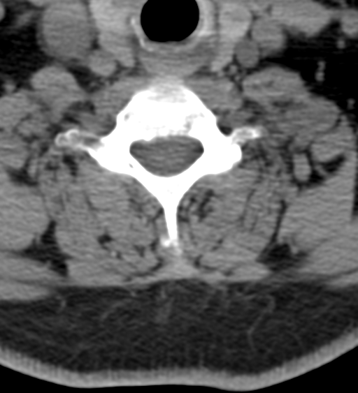 File:Cervical canal stenosis due to ossification of the posterior longitudinal ligament (Radiopaedia 47260-51823 Axial non-contrast 46).png