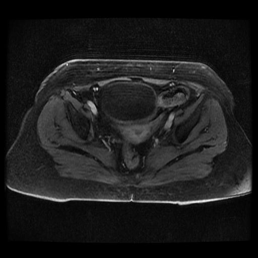 Cervical carcinoma (Radiopaedia 70924-81132 Axial T1 C+ fat sat 143).jpg