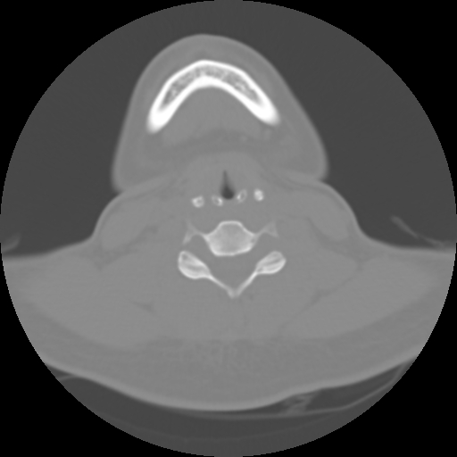 Cervical rib (Radiopaedia 71110-81363 Axial non-contrast 36).jpg