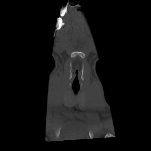 Cervical schwannoma (Radiopaedia 57979-64974 Coronal bone window 6).png