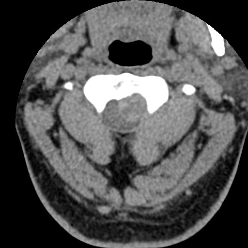 File:Cervical spinal neurofibroma in a patient with NF1 (Radiopaedia 58344-65464 Axial non-contrast 20).jpg