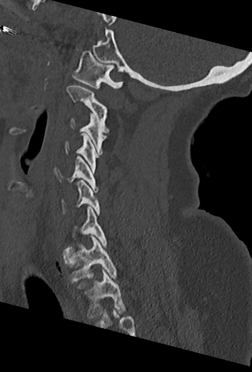 Cervical spine ACDF loosening (Radiopaedia 48998-54070 Sagittal bone window 57).png