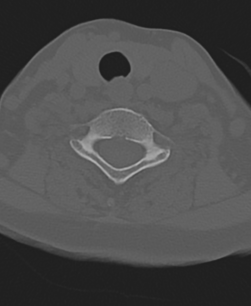 Cervical spine ACDF loosening (Radiopaedia 48998-54071 Axial bone window 44).png