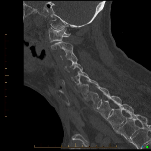 Cervical spine fracture - ankylosing spondylitis (Radiopaedia 76835-88706 Sagittal bone window 42).jpg