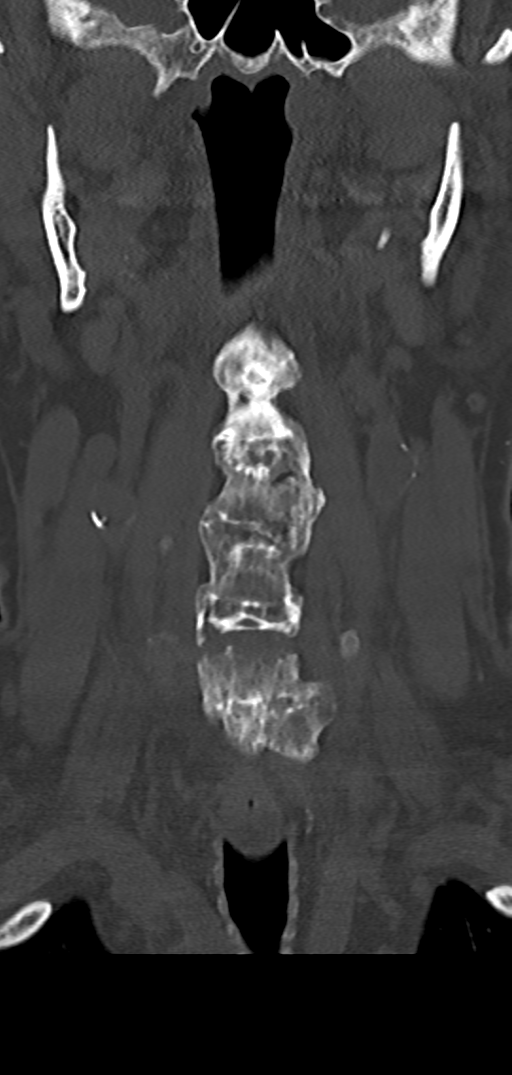 Cervical spine fracture - chalk stick (Radiopaedia 39116-41323 Coronal bone window 13).png