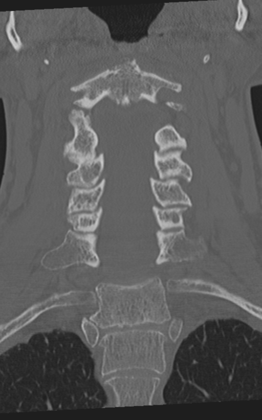 Cervical spine fractures with vertebral artery dissection (Radiopaedia 53296-59268 Coronal bone window 32).png