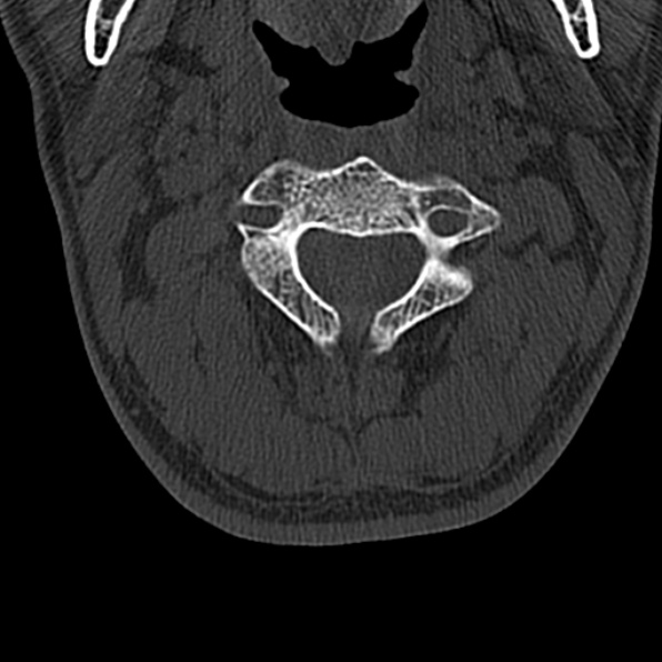 Cervical spondylodiscitis (Radiopaedia 28057-29489 Axial bone window 27).jpg