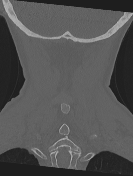 Cervical spondylolysis (Radiopaedia 49616-54811 Coronal bone window 50).png