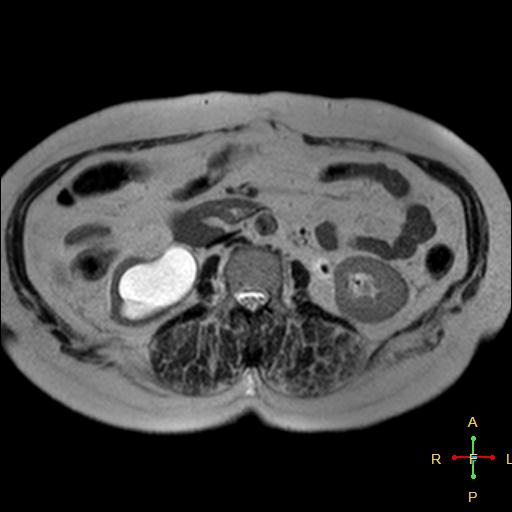 File:Cervical stump squamous cell carcinoma (Radiopaedia 48049-52858 I 1).jpg